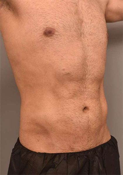 Liposuction Before & After Patient #704