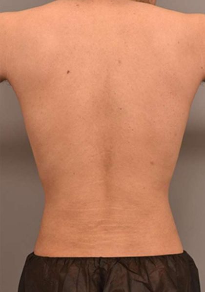 Liposuction Before & After Patient #749