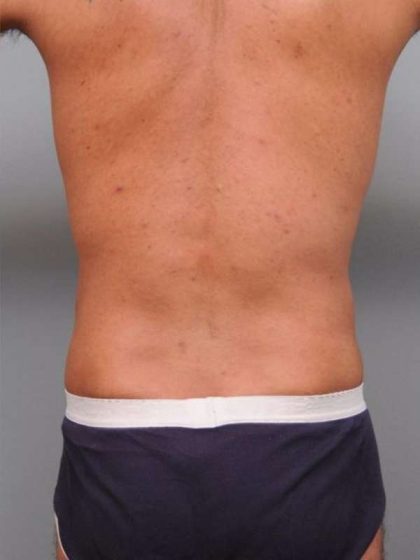Liposuction Before & After Patient #783