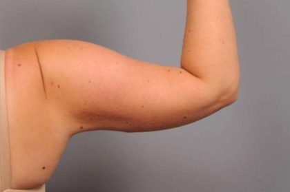 Arm Liposuction Before & After Patient #842