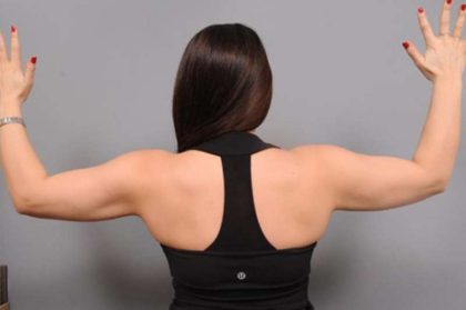 Arm Liposuction Before & After Patient #851