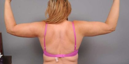 Arm Liposuction Before & After Patient #872