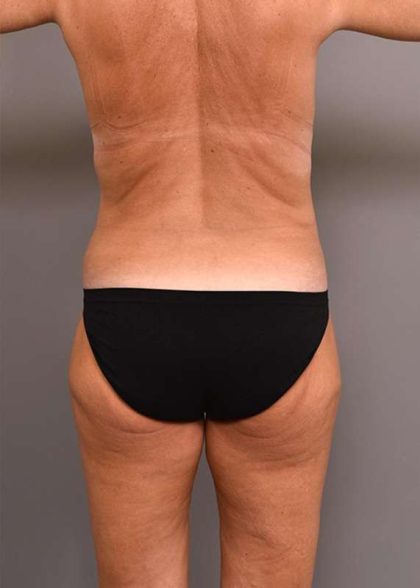 Upper Body Lift Before & After Patient #905