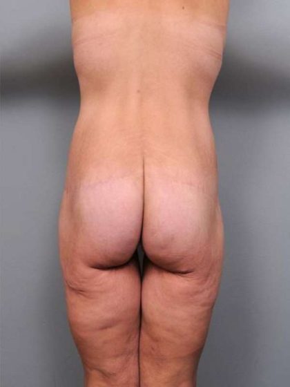 Lower Body Lift Before & After Patient #925