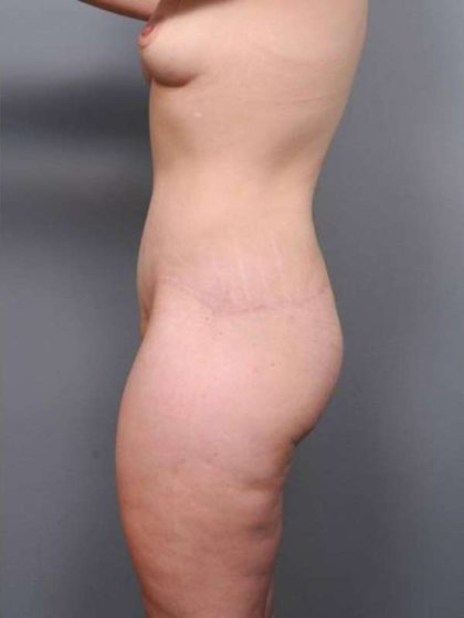 Lower Body Lift Before & After Patient #941