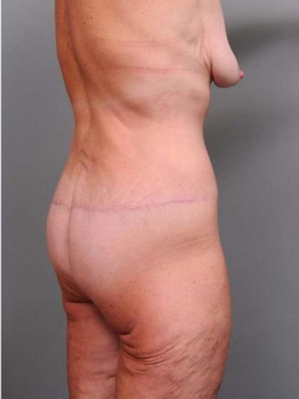 Lower Body Lift Before & After Patient #965