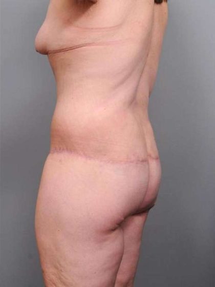 Lower Body Lift Before & After Patient #985