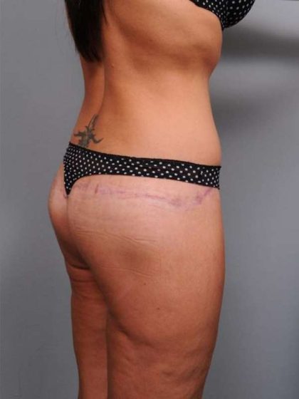 Lower Body Lift Before & After Patient #1010