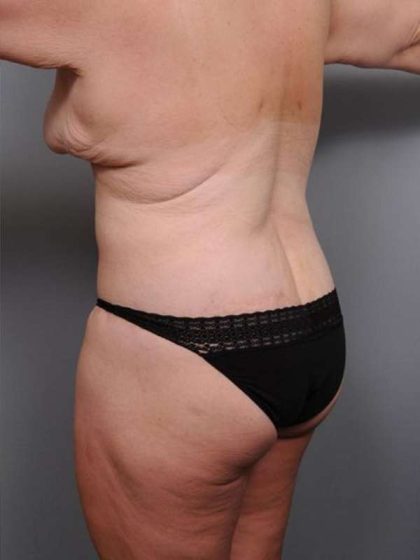 Lower Body Lift Before & After Patient #1027