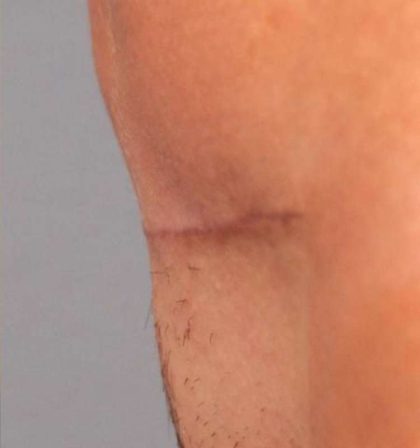 Scar Revision Before & After Patient #1071