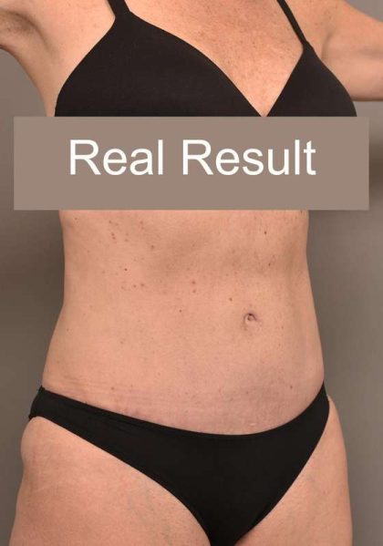 Tummy Tuck Before & After Patient #296