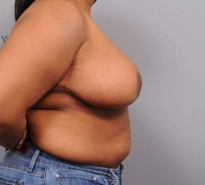 Breast Reduction Before & After Patient #1293