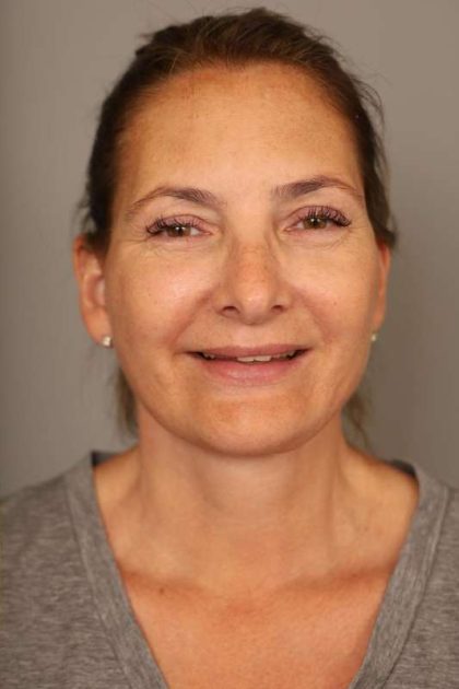 Facelift Before & After Patient #1380