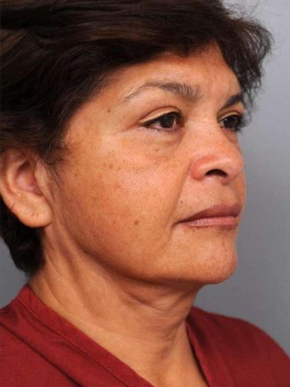 Facelift Before & After Patient #1399