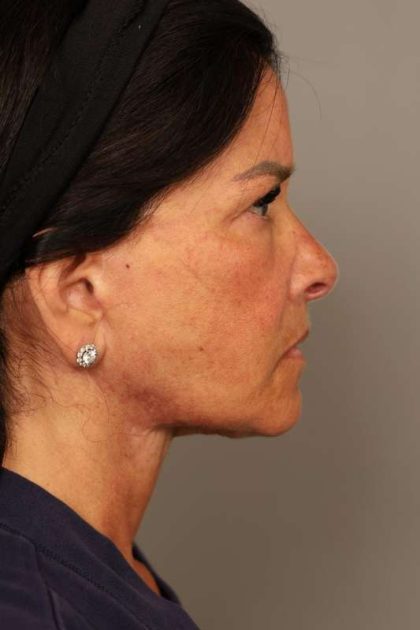 Facelift Before & After Patient #1427
