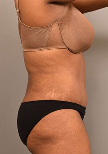 Tummy Tuck Before & After Patient #312