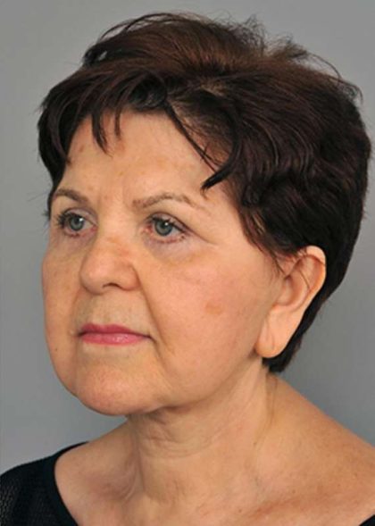 Facelift Before & After Patient #1436