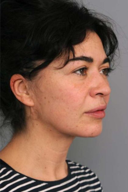 Naturalift™ Mini Facelift Before & After Patient #1474