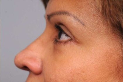 Eyelid Surgery Before & After Patient #1490