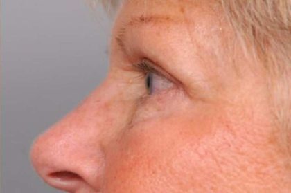 Eyelid Surgery Before & After Patient #1504