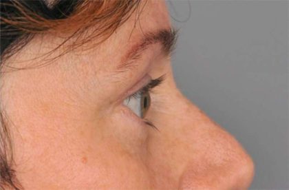 Eyelid Surgery Before & After Patient #1550