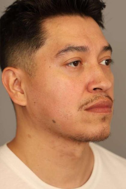 Mini Neck Lift (Single Incision) Before & After Patient #1630
