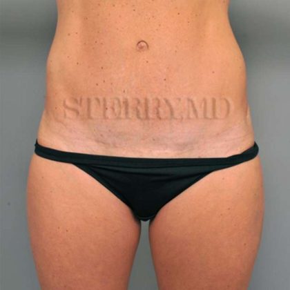 Tummy Tuck Before & After Patient #338