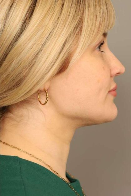 Neck Liposuction / Chin Liposuction Before & After Patient #1703