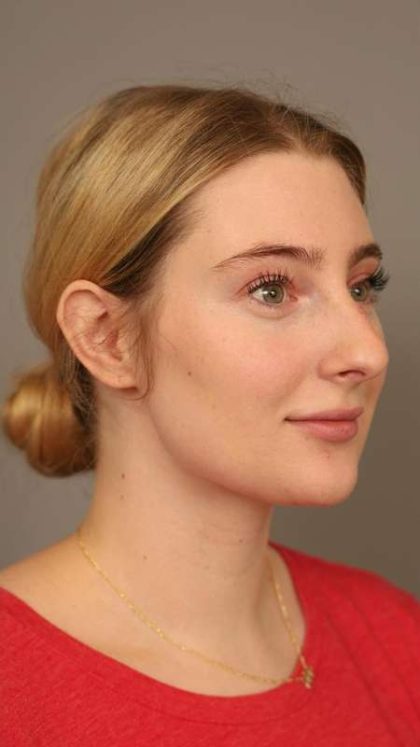Neck Liposuction / Chin Liposuction Before & After Patient #1734