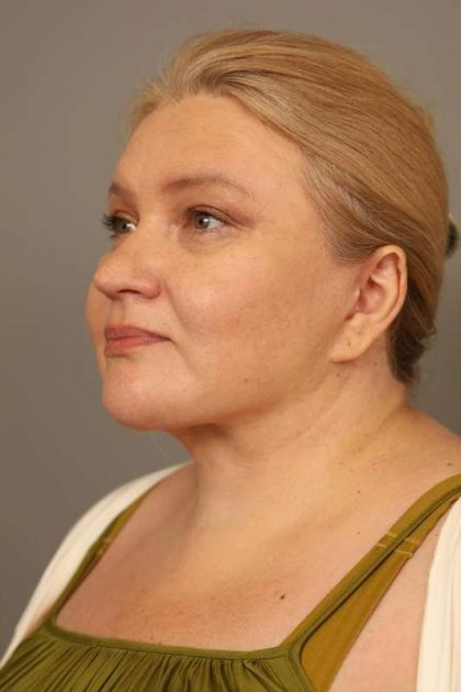 Neck Liposuction / Chin Liposuction Before & After Patient #1743