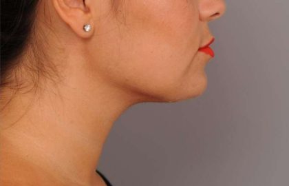 Neck Liposuction / Chin Liposuction Before & After Patient #1770