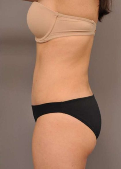 Tummy Tuck Before & After Patient #354