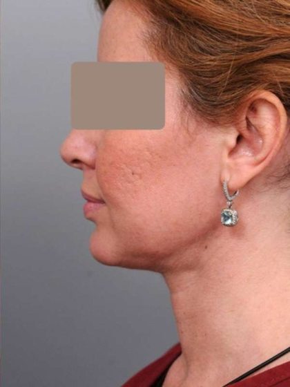 Neck Liposuction / Chin Liposuction Before & After Patient #1946