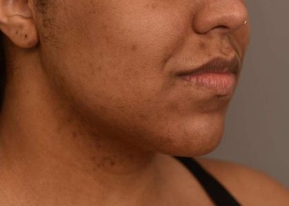 Neck Liposuction / Chin Liposuction Before & After Patient #1978