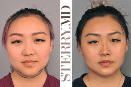 Neck Liposuction / Chin Liposuction Before & After Patient #2011