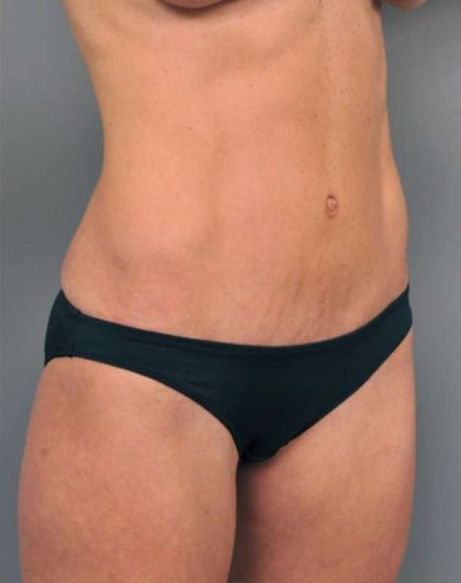 Tummy Tuck Before & After Patient #363