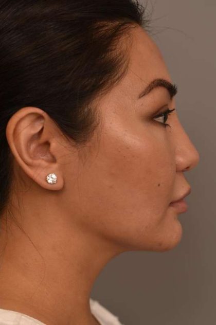 Cheek Liposuction Before & After Patient #2136
