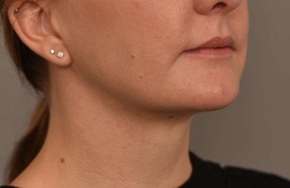 Cheek Liposuction Before & After Patient #2165