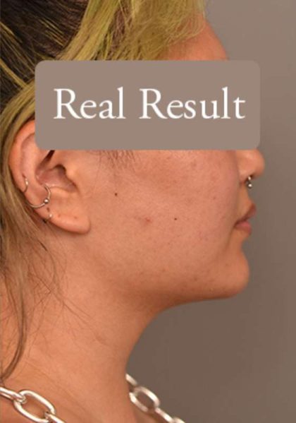 Cheek Liposuction Before & After Patient #2179