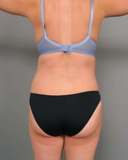 Tummy Tuck Before & After Patient #386