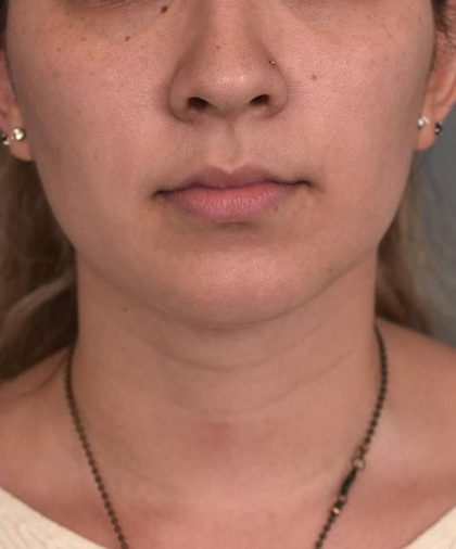 Chin Implant Before & After Patient #2278