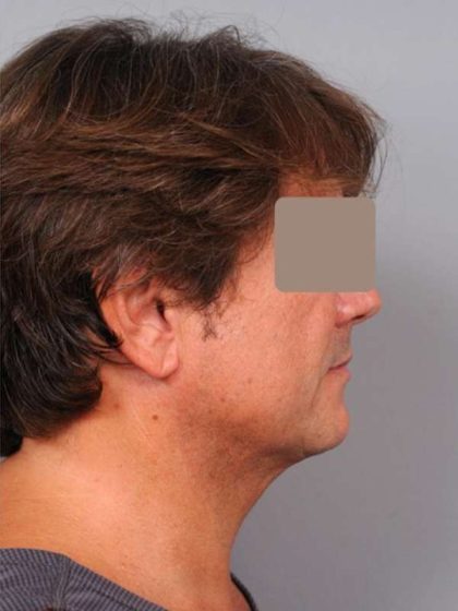 Neck Liposuction For Men Before & After Patient #2419