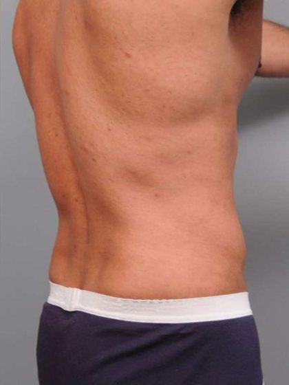 Liposuction Before & After Patient #783