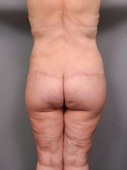 Lower Body Lift Before & After Patient #916