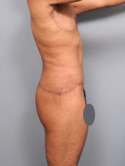 Lower Body Lift Before & After Patient #952