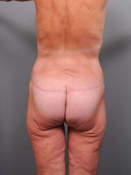 Lower Body Lift Before & After Patient #965
