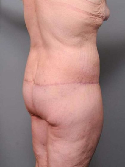 Lower Body Lift Before & After Patient #985