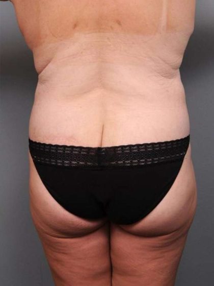 Lower Body Lift Before & After Patient #1027