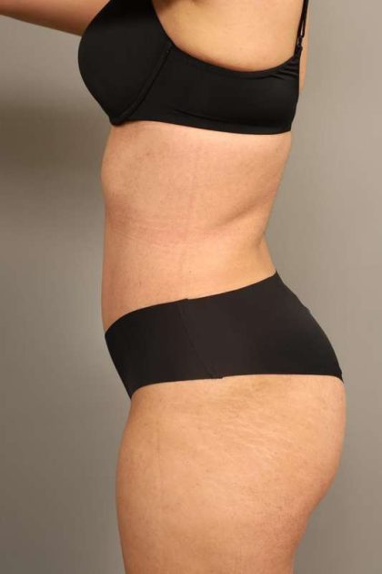 Tummy Tuck Before & After Patient #238