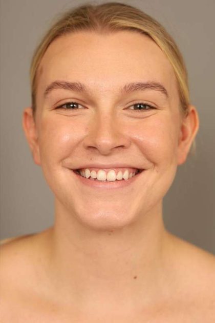 Mini Neck Lift (Single Incision) Before & After Patient #1690